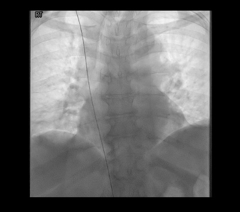 Fluoroscopy showing wire passed to IVC confirming venous position