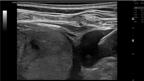Ultrasound of internal jugular vein access