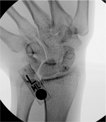 Fluoroscopic image showing needle placement in the radiocarpal joint for wrist arthrogram