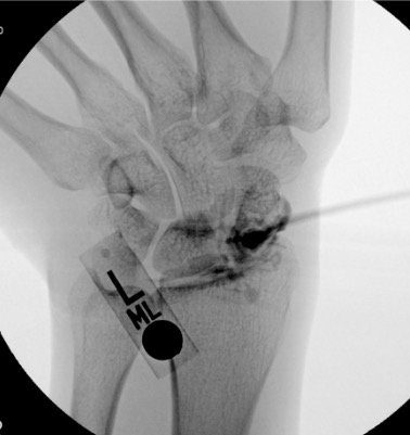 Wrist arthrogram post-injection showing contrast within the radiocarpal compartment