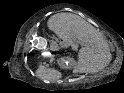 CT-guided ablation probe positioned within adrenal mass with planned ablation zone