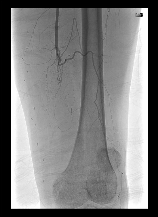 Lower extremity angiogram demonstrating acute occlusion with classic meniscus sign
