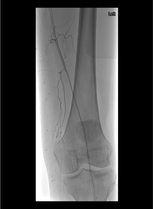 Completion angiogram after catheter-directed thrombolysis showing restored flow in previously occluded artery