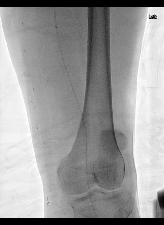 Fluoroscopy showing multi-sidehole lysis catheter positioned within occluded lower extremity artery for CDT