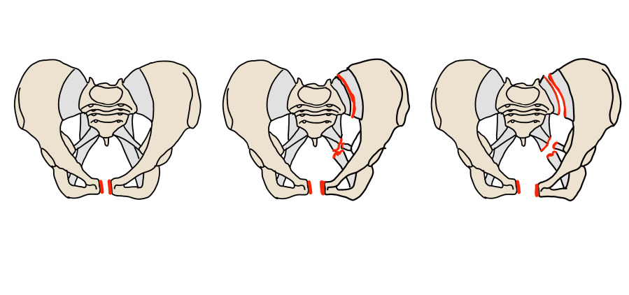 APC anteroposterior compression: APC I minimal symphysis diastasis, APC II open book with anterior SI disruption, APC III complete ring disruption