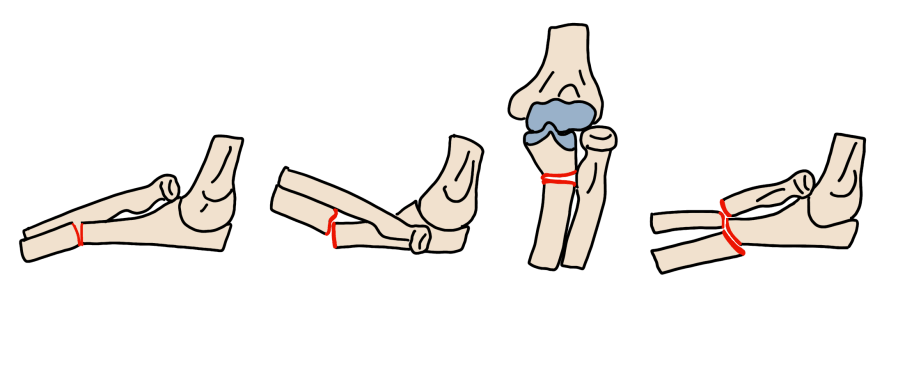 Bado classification: Type I anterior ulna apex with anterior radial head dislocation (most common); Type II posterior; Type III pediatric lateral; Type IV both-bone fracture