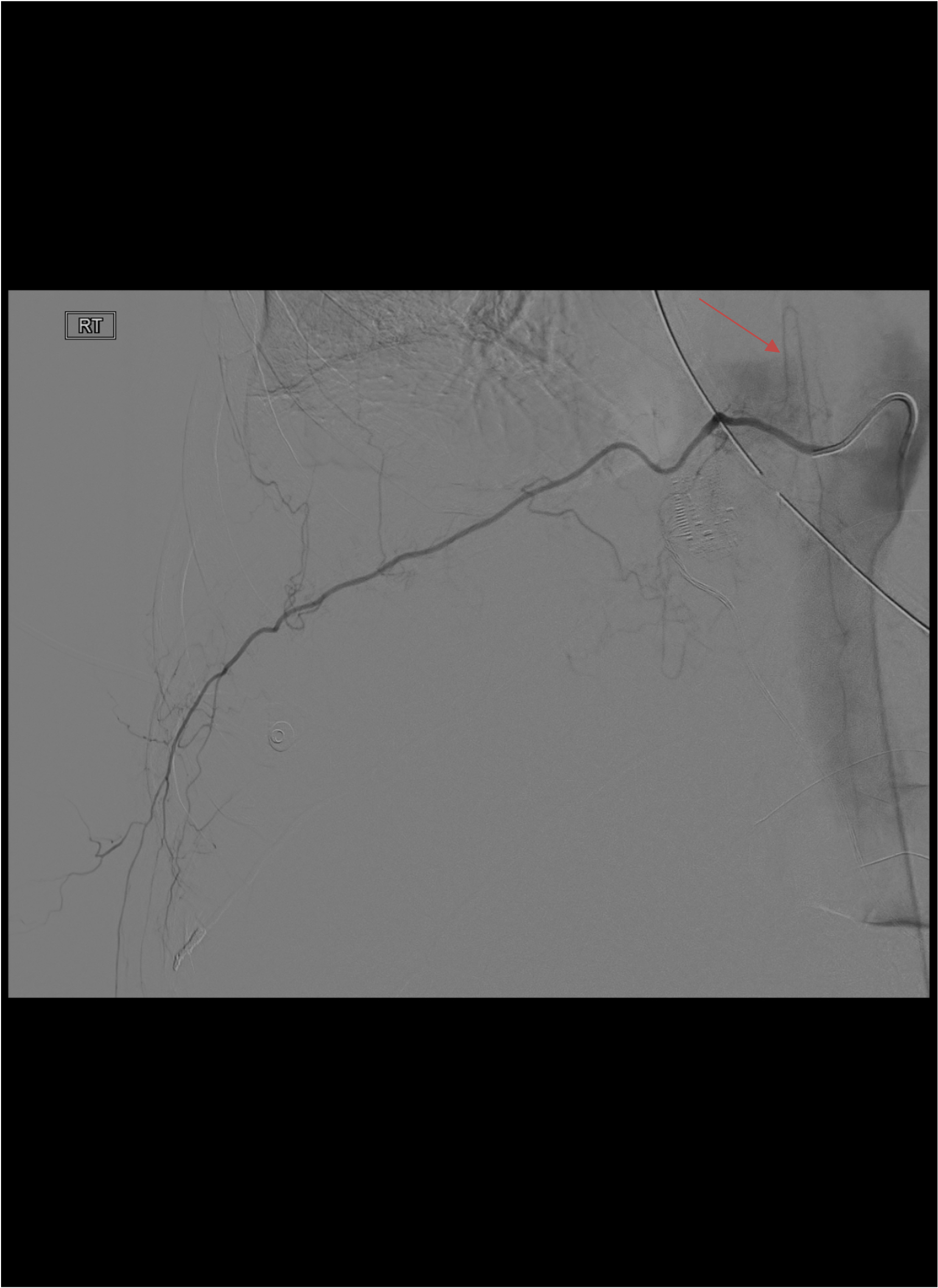 Intercostal angiogram demonstrating anterior spinal artery (red arrow) — critical danger structure before BAE