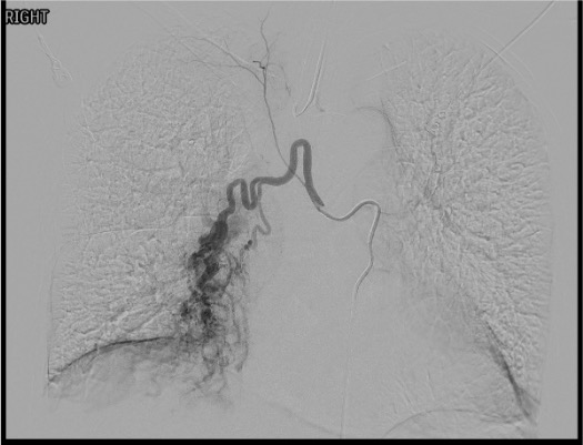 Descending thoracic aortogram showing hypertrophied bronchial arteries in a patient with hemoptysis
