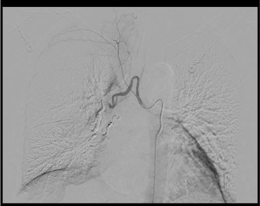Completion angiogram after bronchial artery embolization showing devascularization
