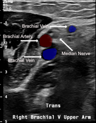 Labeled ultrasound of right brachial vein upper arm showing brachial artery, paired brachial veins, and brachial nerve
