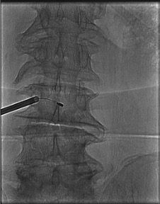 AP fluoroscopy showing pedicle en face 'owl eye' view confirming correct needle trajectory for BVA