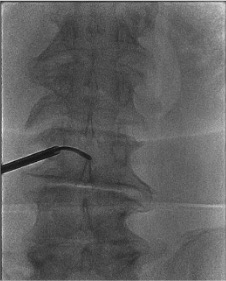AP fluoroscopy showing Intracept RF probe deployed in basivertebral foramen during active ablation
