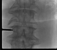 Lateral fluoroscopy showing transpedicular trocar advanced to posterior vertebral body for BVA