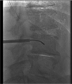 AP fluoroscopy planning view for unipedicular basivertebral nerve ablation approach