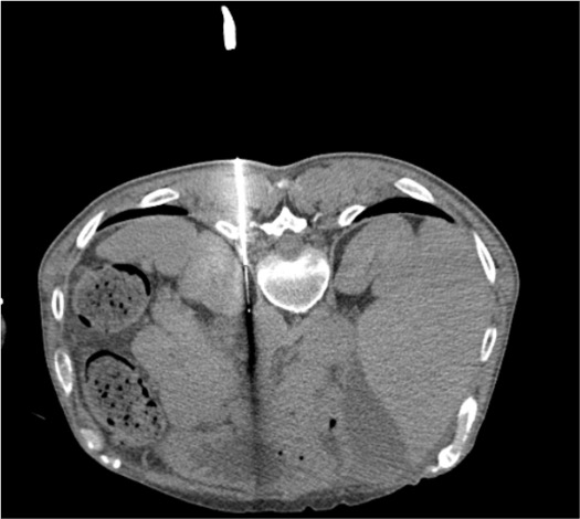 CT showing bilateral cryoablation probes positioned at celiac ganglia for celiac plexus cryoablation