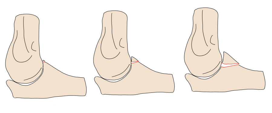 O'Driscoll coronoid process fracture classification — tip, anteromedial facet, and basal subtypes