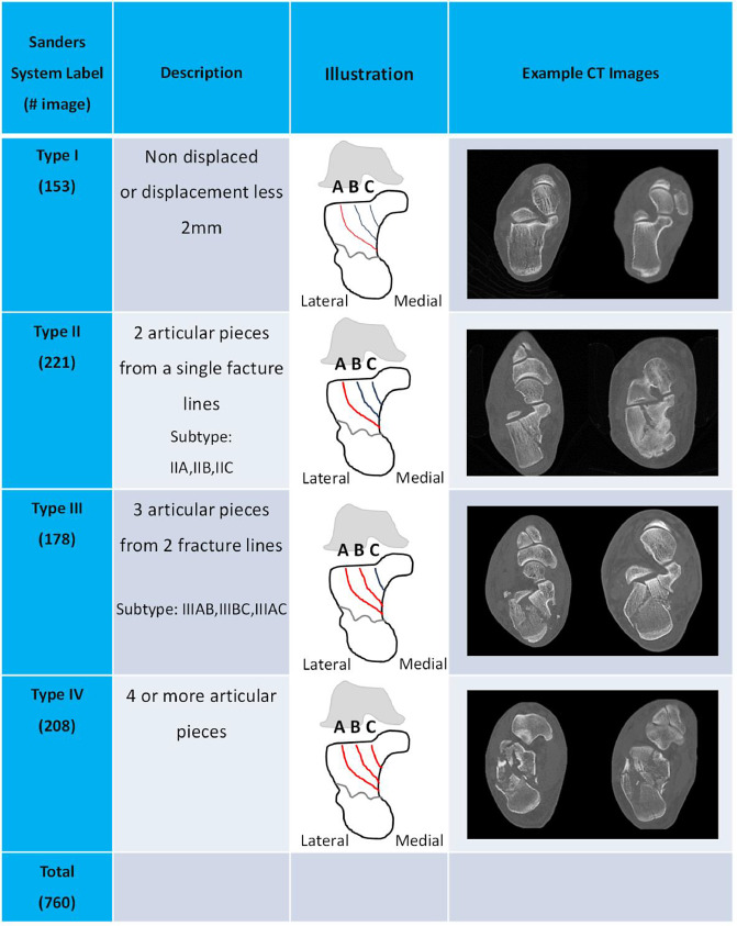 Sanders CT classification of calcaneal fractures: I nondisplaced; II two-part; III three-part; IV comminuted — based on coronal CT at posterior facet