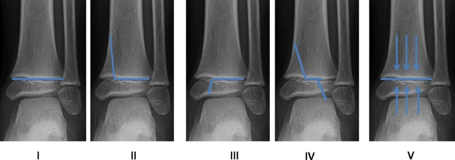 Salter-Harris classification of physeal fractures: I through physis; II through physis and metaphysis (most common); III through physis and epiphysis; IV through all three; V crush injury of physis