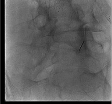 Fluoroscopic arthrogram demonstrating contrast within lumbar facet joint confirming intra-articular needle position