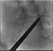 AP fluoroscopy showing needle in lumbar facet joint confirming intra-articular position