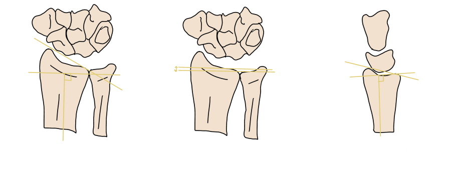 Distal radius radiographic measurements — radial inclination, ulnar variance, and volar tilt on PA and lateral views