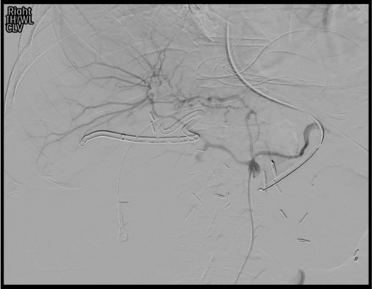 Celiac angiogram demonstrating active extravasation from gastroduodenal artery blowout