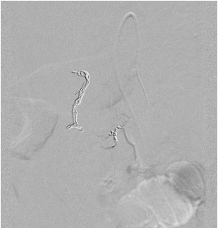 Coil embolization of GDA and IPDA as alternative to covered stent in GDA blowout