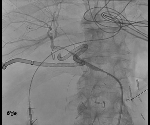 Covered stent deployed across GDA blowout with completion angiogram confirming hemorrhage control