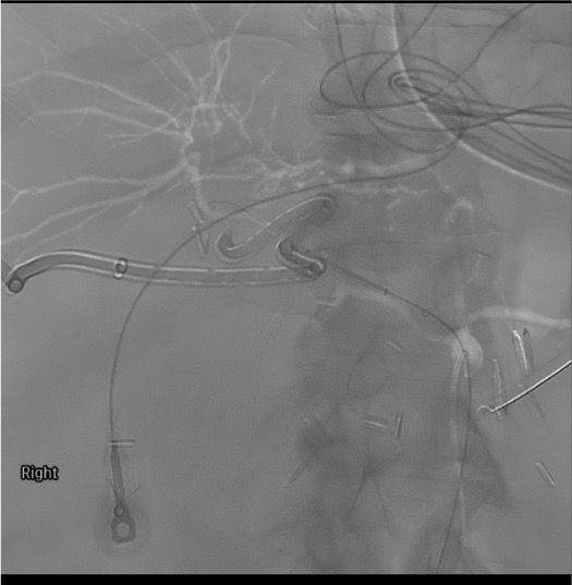 Rosen wire and sheath positioned across GDA defect prior to covered stent deployment