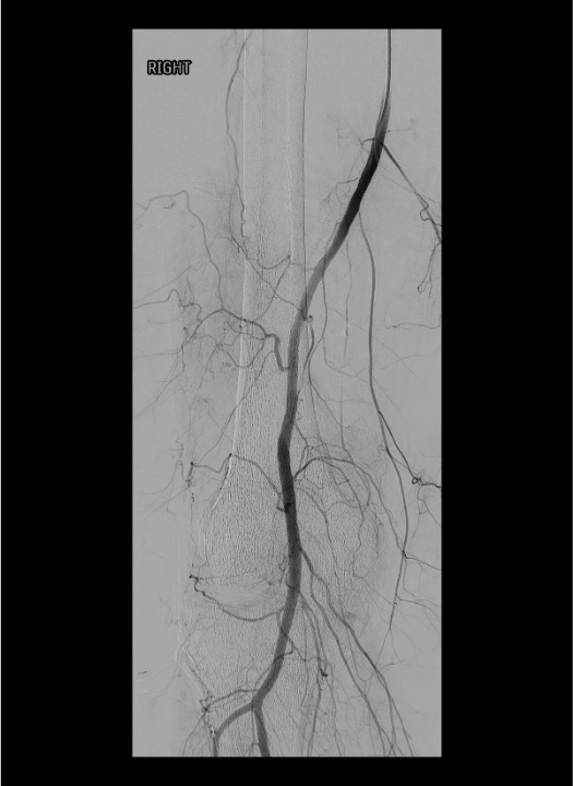 Post-embolization popliteal arteriogram confirming devascularization of targeted genicular branches