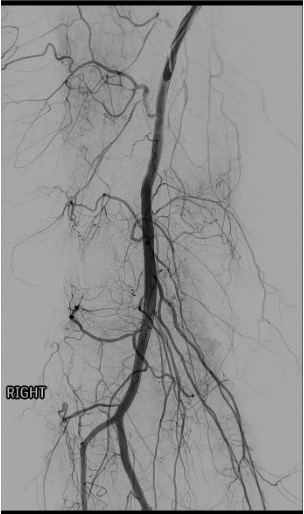 Popliteal arteriogram mapping genicular branches showing hyperemic synovial blush