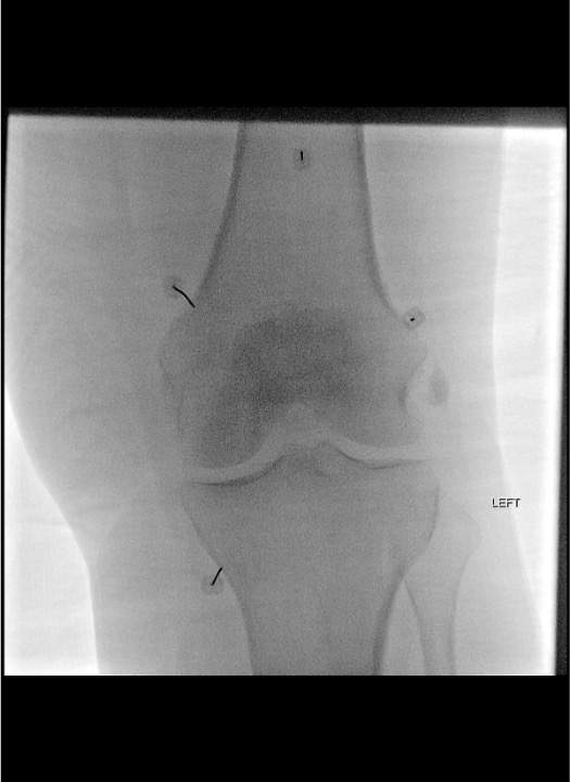AP fluoroscopy showing needles at three genicular nerve targets for diagnostic genicular nerve block