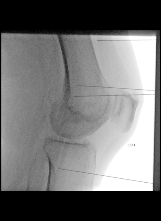 Lateral fluoroscopy confirming RF cannula depth and position at periosteal target for genicular nerve RFA
