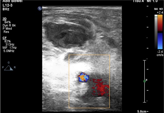 Post-thrombin injection ultrasound demonstrating pseudoaneurysm thrombosis with patent common femoral artery