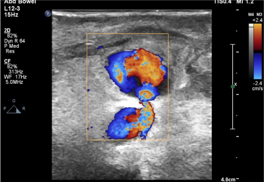 Groin pseudoaneurysm demonstrating characteristic to-and-fro flow adjacent to common femoral artery