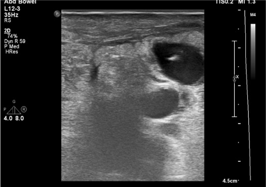 Ultrasound-guided thrombin injection into pseudoaneurysm sac with needle visible in sac