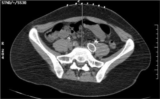 CT confirming bilateral needle tips in retroperitoneal space at L5-S1 for superior hypogastric plexus block