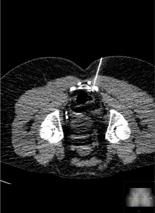 CT showing needle positioned at inferior hypogastric plexus target in parametrial space
