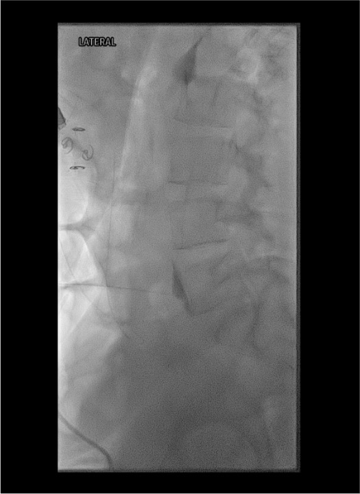 Lateral fluoroscopy confirming needle position anterior to L5-S1 disc for superior hypogastric plexus block