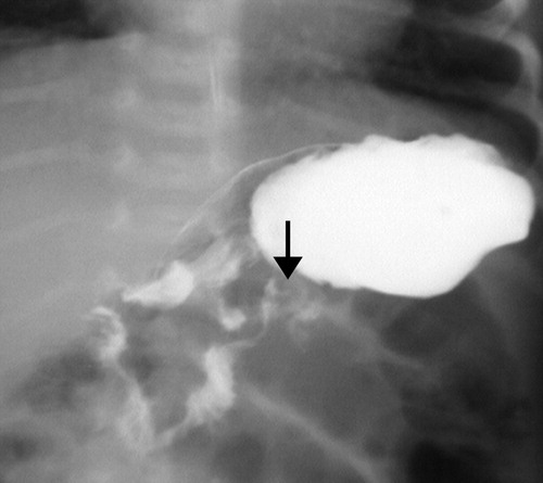 Normal UGI showing DJJ to the left of midline at the level of the duodenal bulb