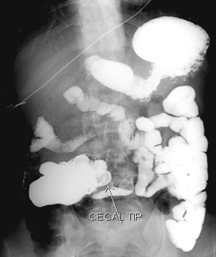 Abnormal cecal position in the right upper quadrant suggesting malrotation