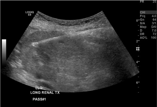Ultrasound showing needle positioned tangentially in renal cortex during transplant biopsy