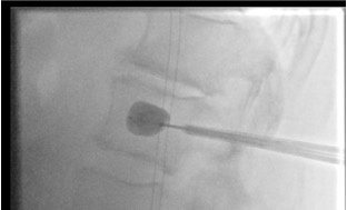 Bilateral balloon inflation in fractured vertebra creating cavity for cement during kyphoplasty