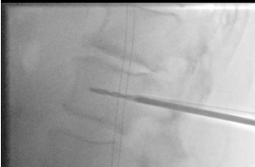 Lateral fluoroscopy showing drill advancing through vertebral body to create working channel for balloon kyphoplasty