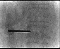 AP fluoroscopy confirming bilateral pedicular trocar access for kyphoplasty