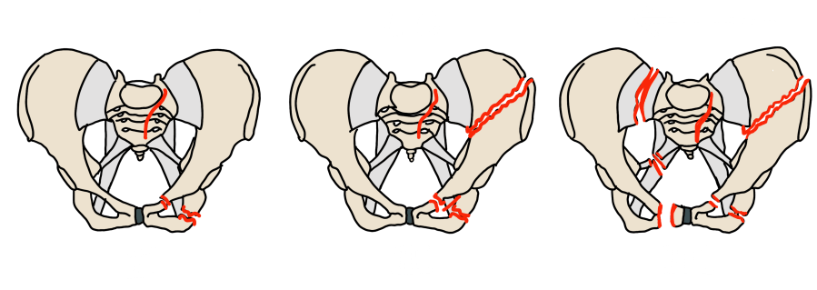 Lateral compression pelvic fractures: LC I sacral compression, LC II crescent fracture, LC III windswept pelvis