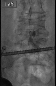 Epidurogram after interlaminar injection showing bilateral contrast spread in epidural space