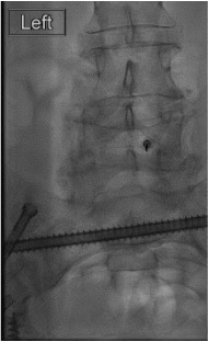 Lateral fluoroscopy showing interlaminar epidural needle at posterior epidural space after loss of resistance