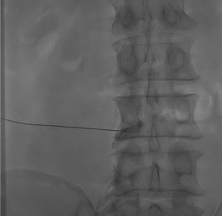 Fluoroscopic epidurogram showing contrast spread in transforaminal epidural space confirming needle position