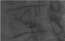 Fluoroscopy showing transforaminal epidural needle at the safe triangle below the pedicle